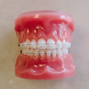 clear braces model