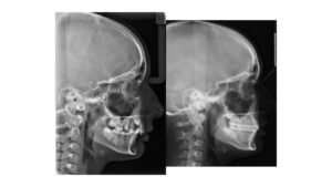 before and after x ray image from side profile