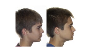 before and after image from side profile