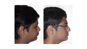 before and after image from side profile