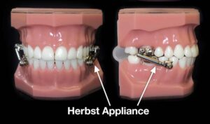 3d model of herbst device