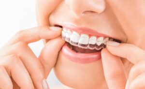 invisalign smile