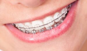 smile with braces