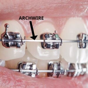 archwire on braces