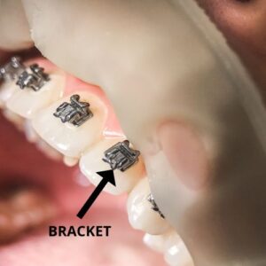 bracket on tooth