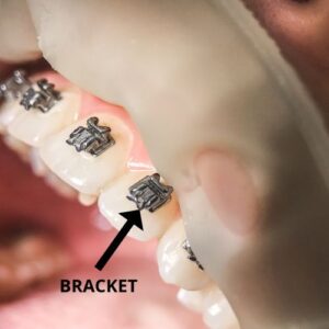 bracket on braces