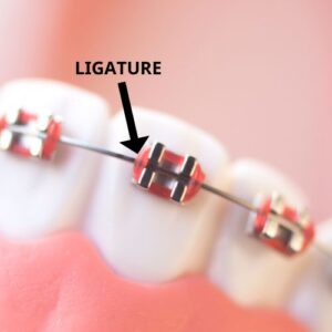 ligature on braces