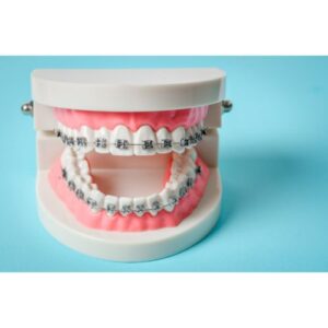 teeth model with braces