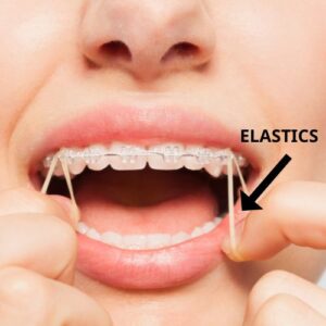 rubber bands on braces