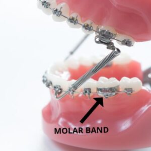 molar band on braces