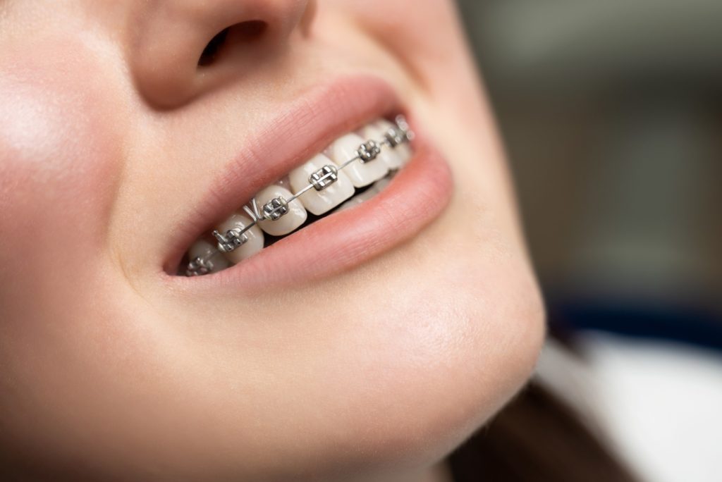 How Long Does it Take to Put on Braces? Full Timeline | Frey Orthodontics