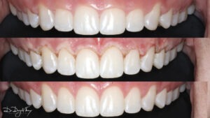 What is Gum Tissue Laser Contouring for Your Smile?